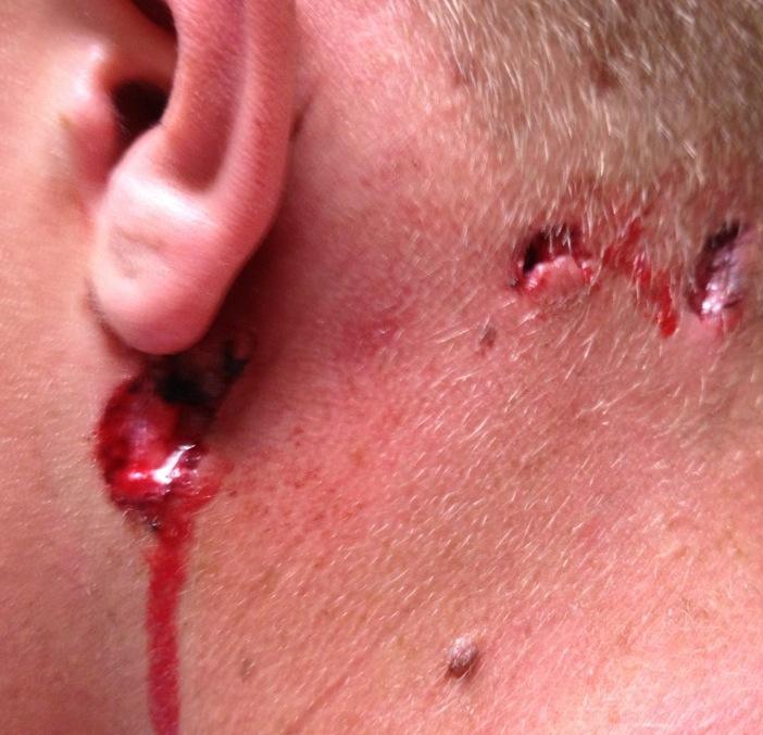 Zacks neck wound, from a bullet that flew came through the wall of Theater 9 into Theater 8